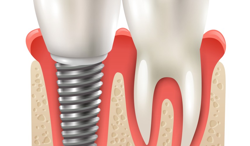 Zubné implantáty