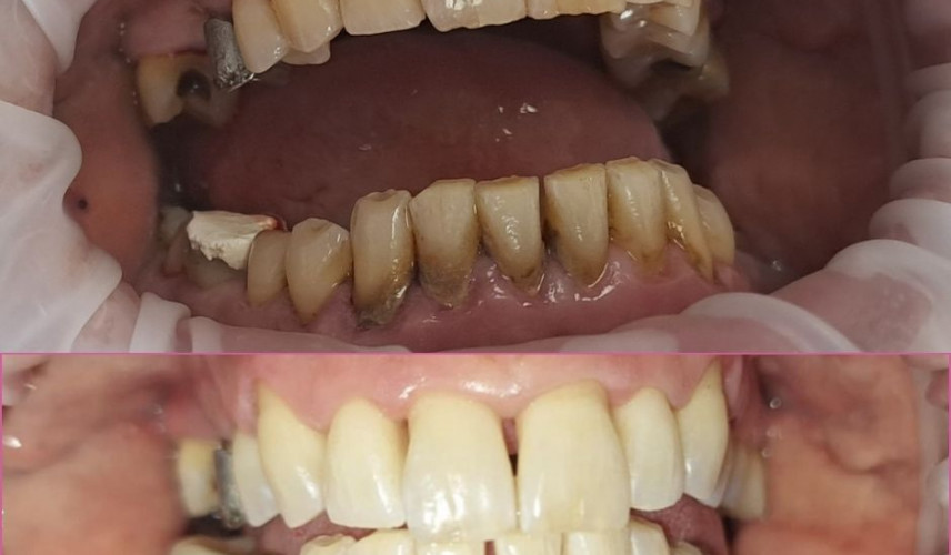 Fotoseriál odstránenia zubného kameňa na dentálnej hygiene