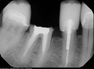 Zlomený zub RTG snímok